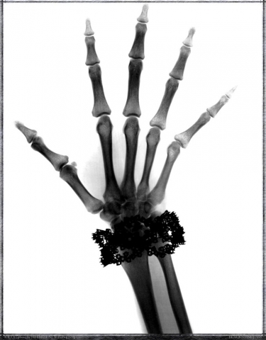 X-ray, 1979